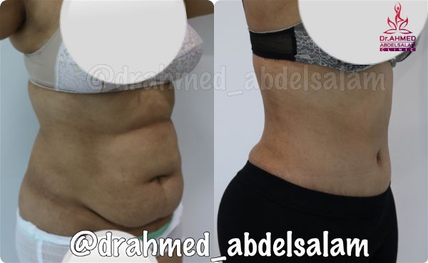 cases in Abdominoplasty