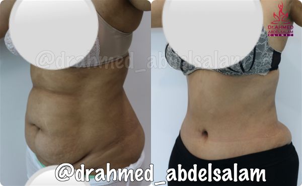 cases in Abdominoplasty