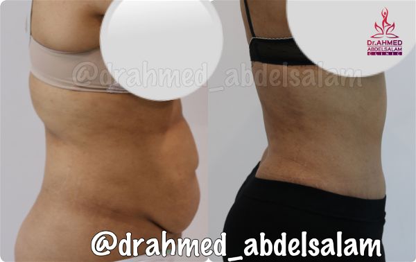 cases in Abdominoplasty