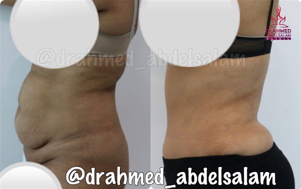 cases in Abdominoplasty