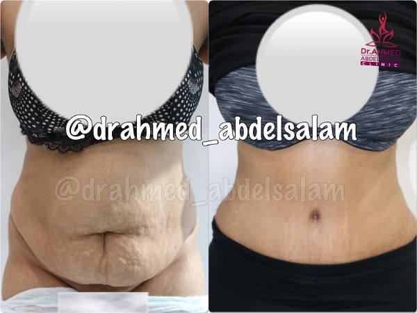 cases in Abdominoplasty