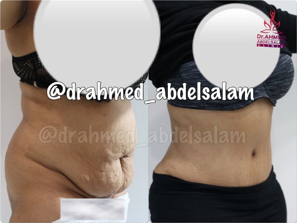 cases in Abdominoplasty