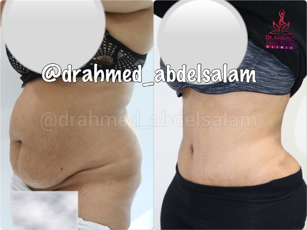 cases in Abdominoplasty