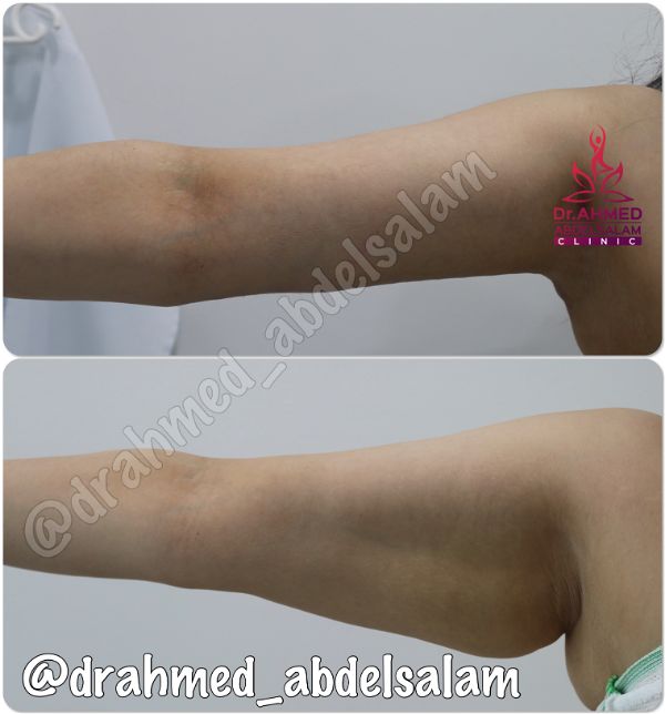 cases in Arm Lift