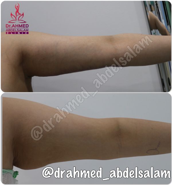 cases in Arm Lift