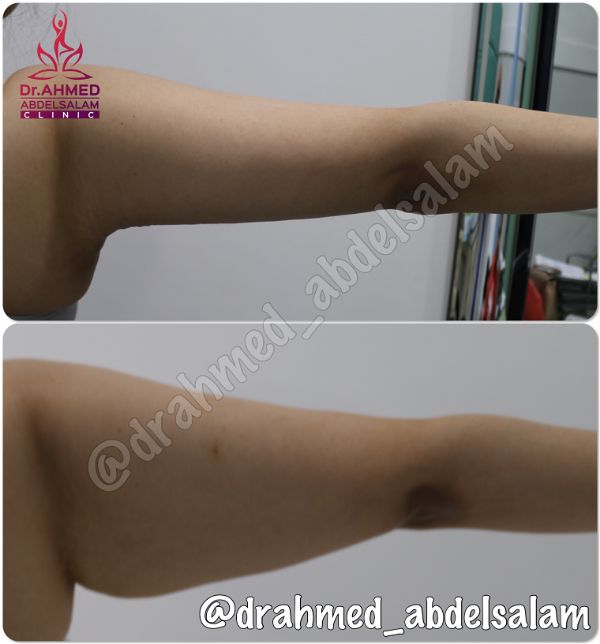 cases in Arm Lift