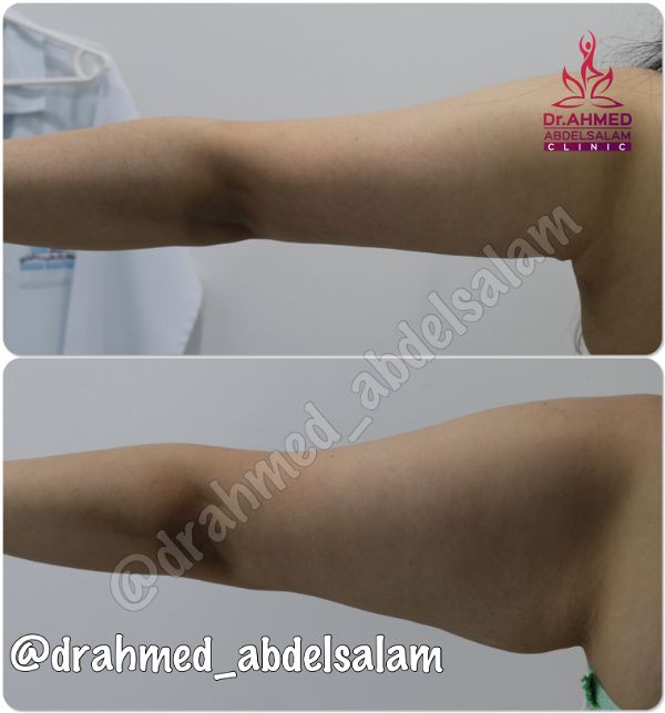 cases in Arm Lift