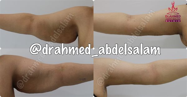 cases in Arm Lift