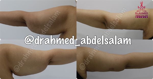 cases in Arm Lift