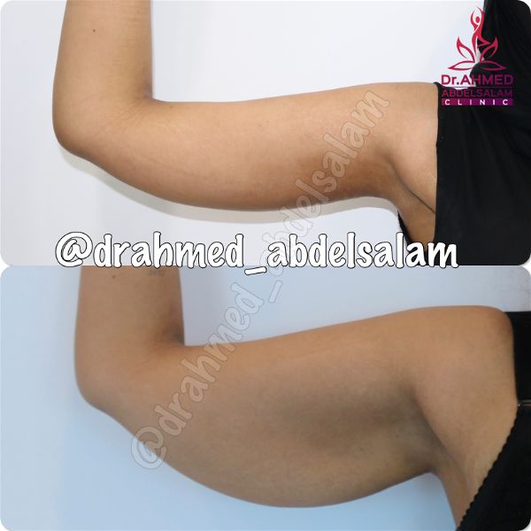 cases in Arm Lift