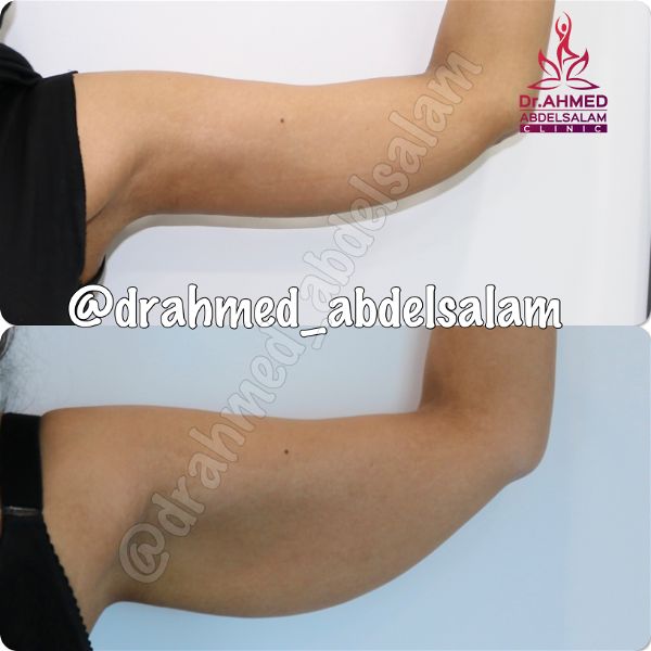 cases in Arm Lift