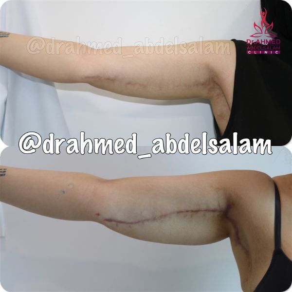 cases in Arm Lift