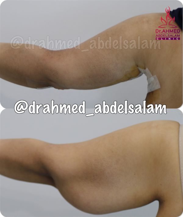 cases in Arm Lift