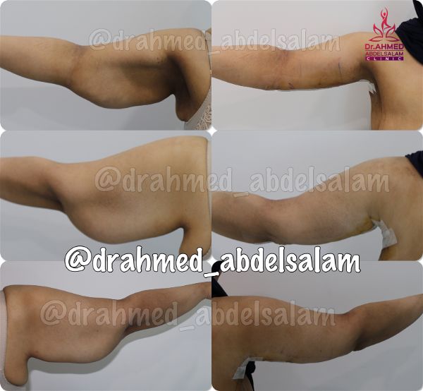 cases in Arm Lift