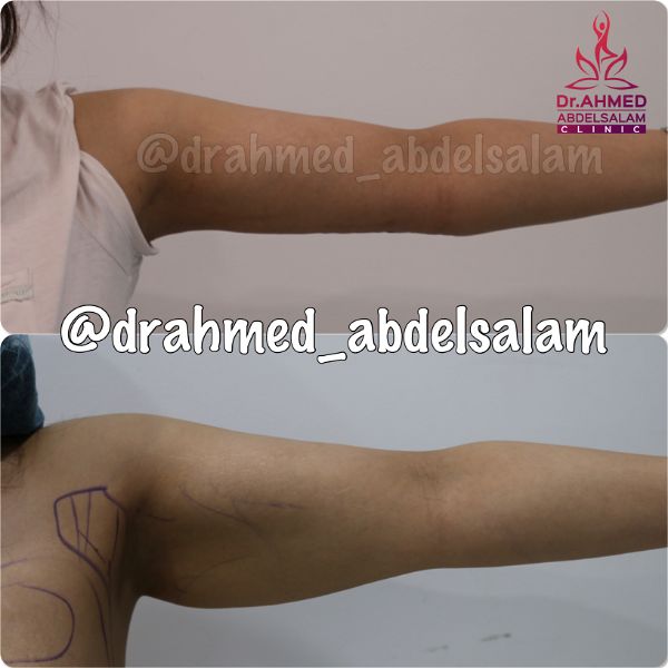 cases in Arm Lift