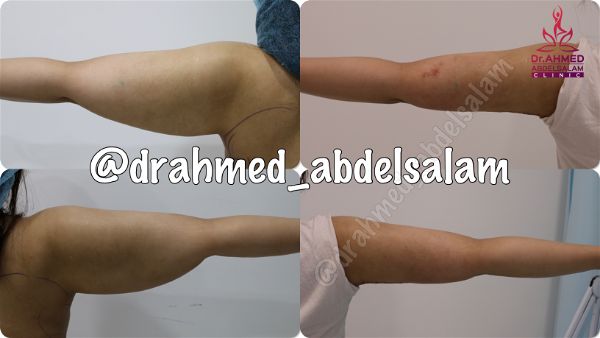 cases in Arm Lift