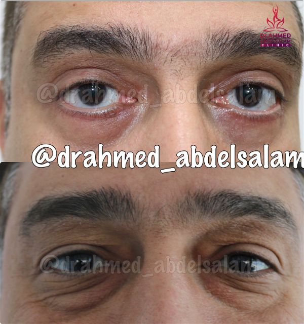 cases in Upper & Lower Blepharoplasty