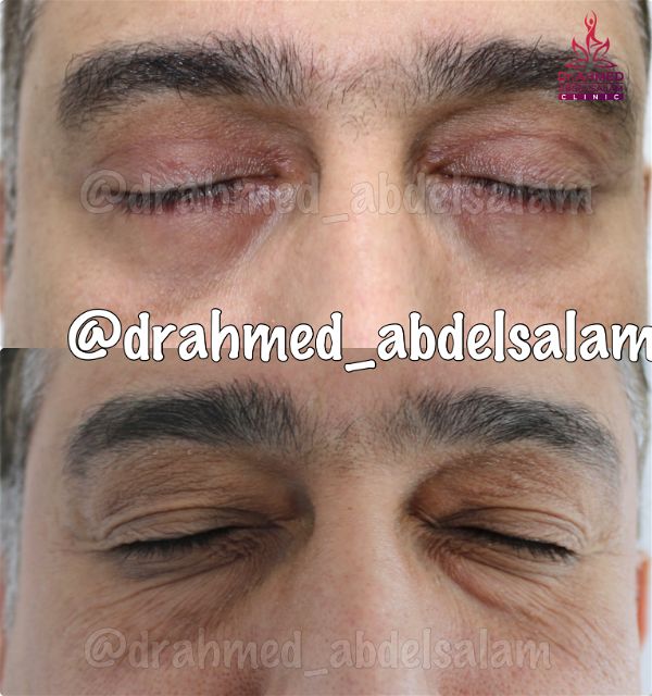 cases in Upper & Lower Blepharoplasty