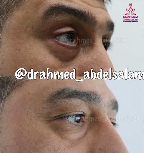 cases in Upper & Lower Blepharoplasty