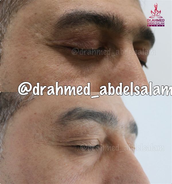 cases in Upper & Lower Blepharoplasty