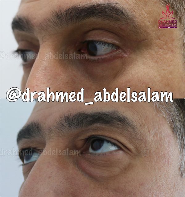 cases in Upper & Lower Blepharoplasty