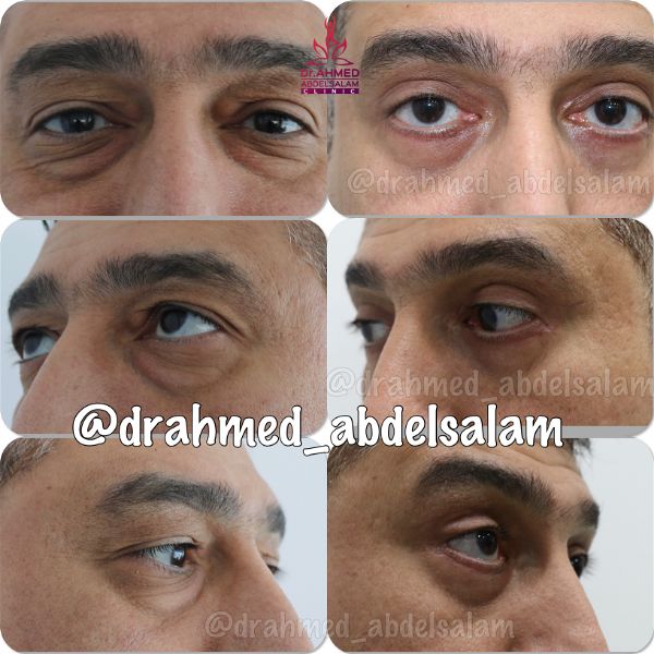 cases in Upper & Lower Blepharoplasty