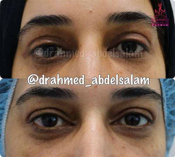 cases in Upper & Lower Blepharoplasty