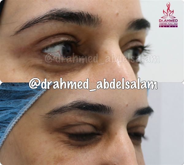 cases in Upper & Lower Blepharoplasty