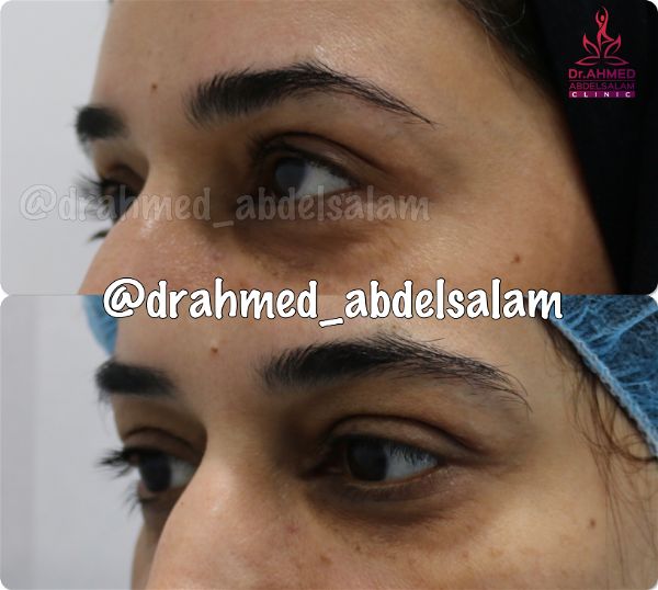 cases in Upper & Lower Blepharoplasty