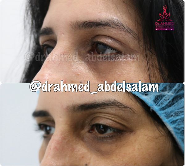 cases in Upper & Lower Blepharoplasty