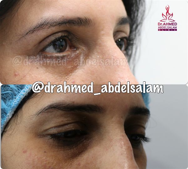 cases in Upper & Lower Blepharoplasty