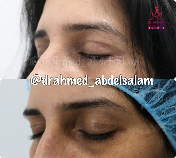 cases in Upper & Lower Blepharoplasty