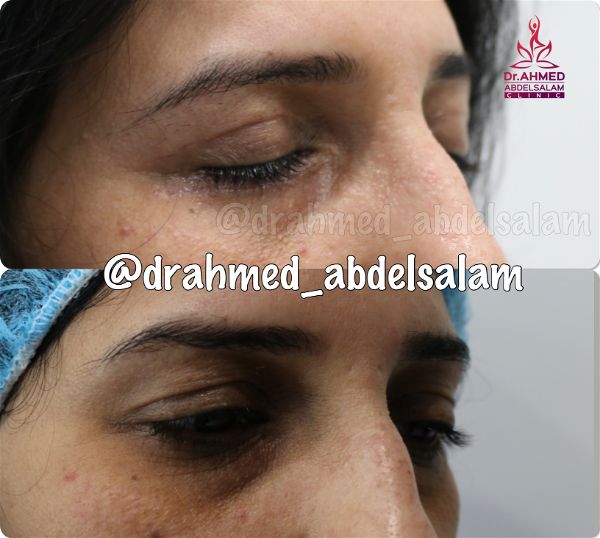 cases in Upper & Lower Blepharoplasty