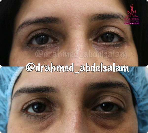 cases in Upper & Lower Blepharoplasty