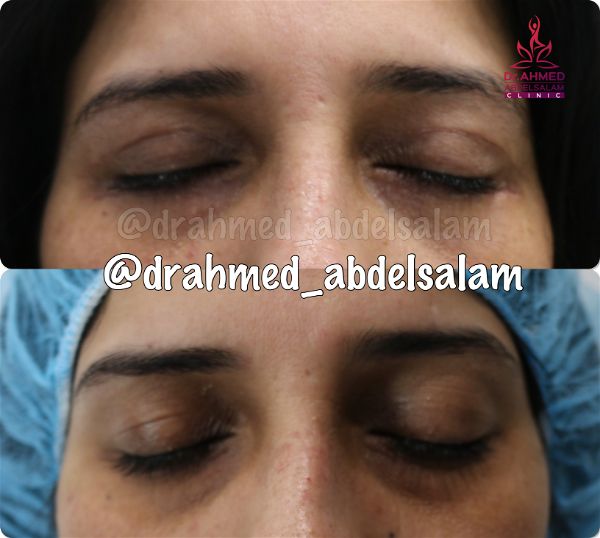 cases in Upper & Lower Blepharoplasty