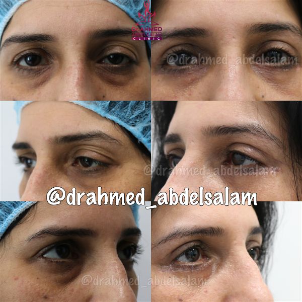 cases in Upper & Lower Blepharoplasty