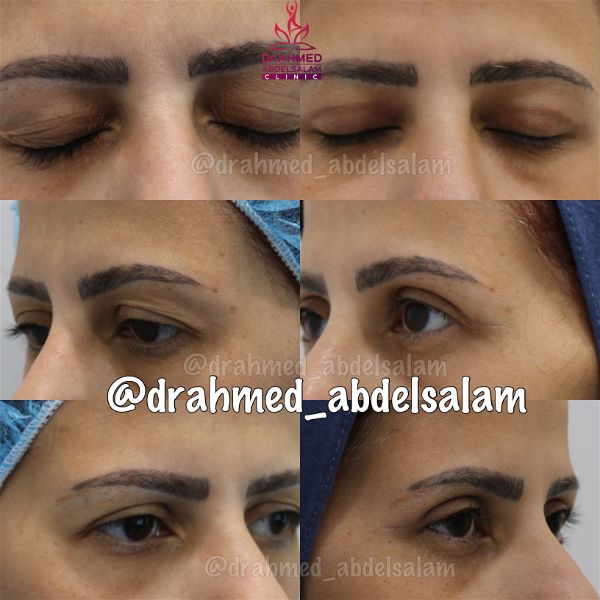 cases in Upper & Lower Blepharoplasty