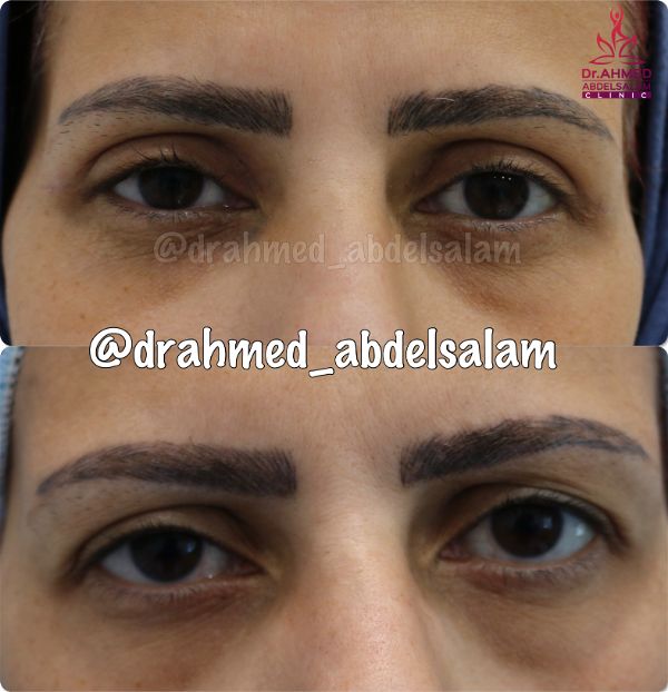 cases in Upper & Lower Blepharoplasty