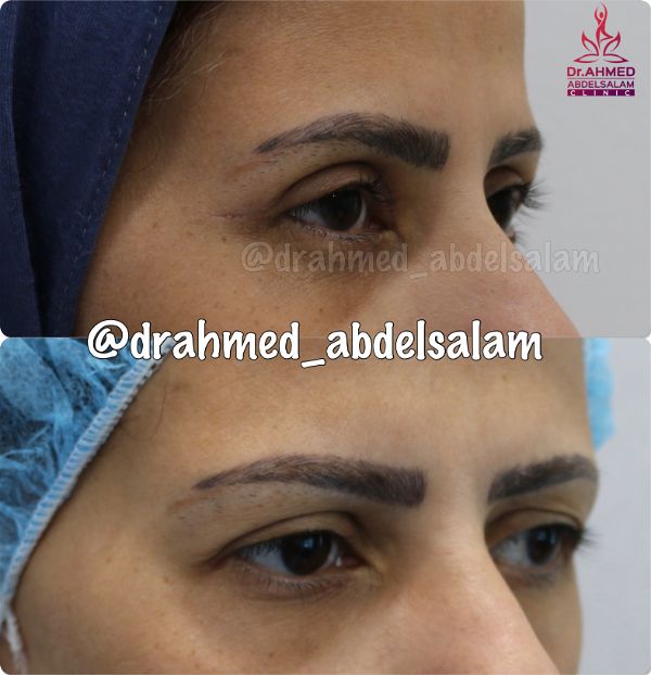 cases in Upper & Lower Blepharoplasty