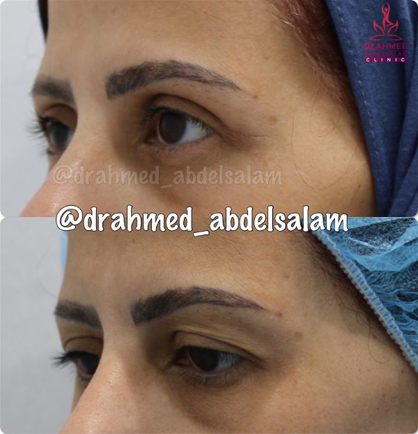 cases in Upper & Lower Blepharoplasty