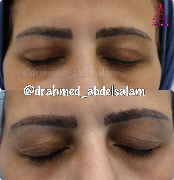 cases in Upper & Lower Blepharoplasty