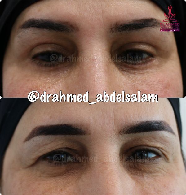 cases in Upper & Lower Blepharoplasty