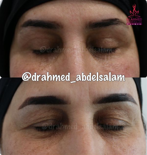 cases in Upper & Lower Blepharoplasty