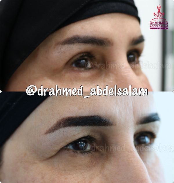 cases in Upper & Lower Blepharoplasty