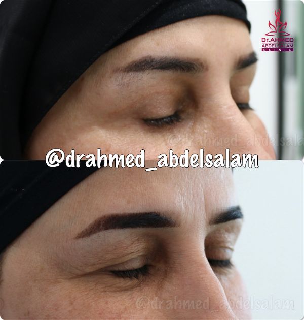 cases in Upper & Lower Blepharoplasty