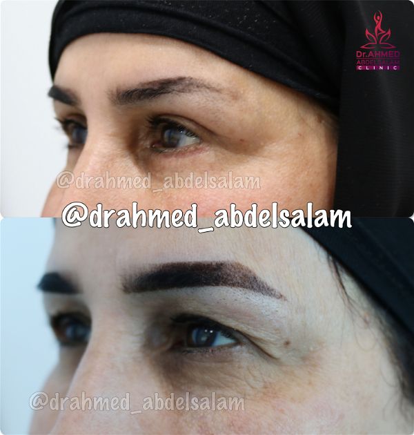 cases in Upper & Lower Blepharoplasty