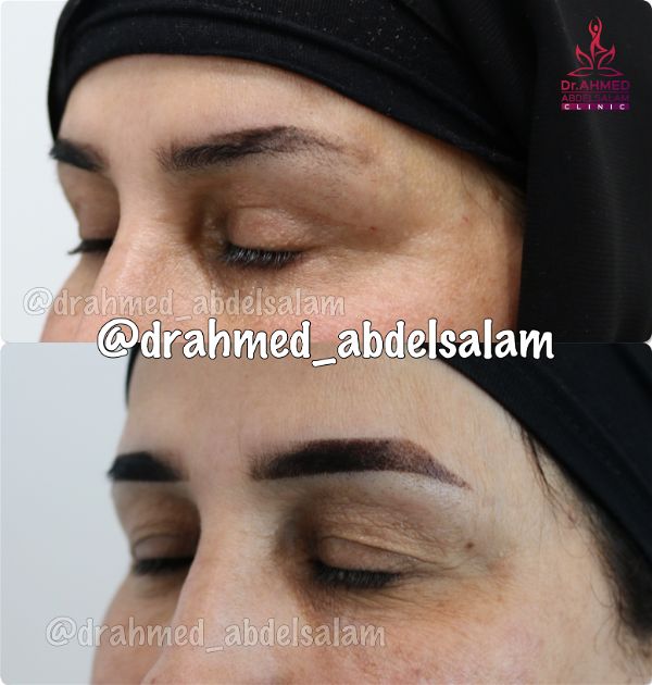 cases in Upper & Lower Blepharoplasty