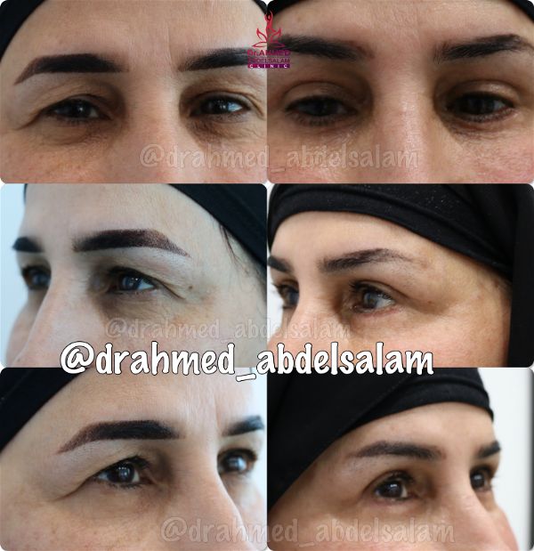 cases in Upper & Lower Blepharoplasty