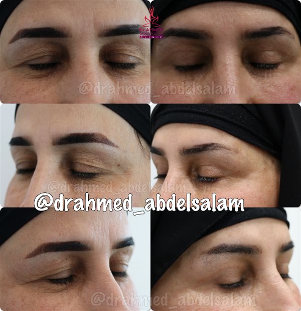 cases in Upper & Lower Blepharoplasty