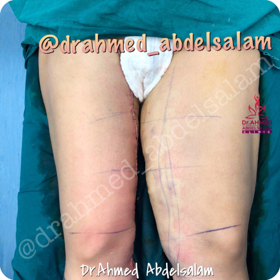 cases in Thigh Lift